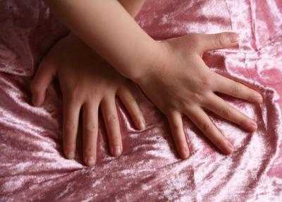 Почему у ребенка на руках слазит кожа
